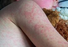 Sarampión brota en los 32 estados del país