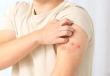 México confirma primer caso de viruela símica variante Ib