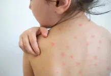 Confirman tercer caso positivo de sarampión; es una bebé de Tlaxcala