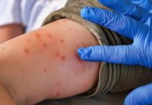 Confirman 26 muertos y más de siete mil casos de sarampión en México