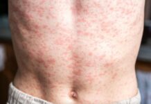 Brote de sarampión en México: Van 28 muertes y CDMX registra su primer deceso