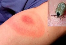 Confirman primer fallecimiento por rickettsia en 2026