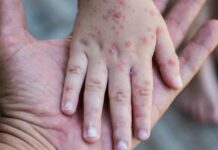 Activan alerta en Costa Rica por niña mexicana con sarampión