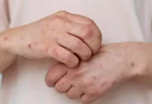 Registra Chihuahua 18 casos de sarampión en 2026