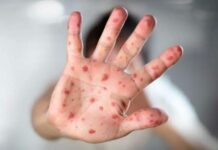 Aumentan a 32 las muertes por sarampión en México