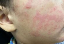 Sarampión en México: Más de 11 mil casos y 32 muertes en el brote actual