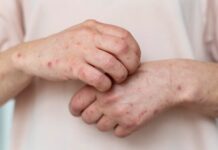 Sarampión en México: Casos superan el total de 2025