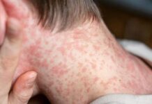 Jalisco supera a Chihuahua en casos de sarampión y se convierte en el estado con más contagios