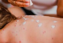 México registra 36 muertes por sarampión y más de 15 mil casos confirmados