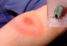 Aumentan más del doble casos de rickettsiosis en Juárez; reportan 15 defunciones en 2026