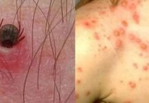 Confirman nuevo caso de rickettsiosis en niña de 10 años; investigan muerte de otra menor